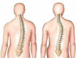 scoliosis